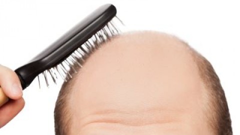 Male Pattern Baldness – Facts and Myths About This Issue